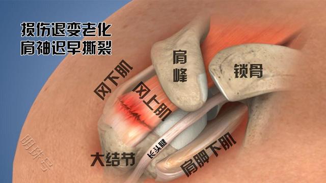 肩颈粘连图片图片