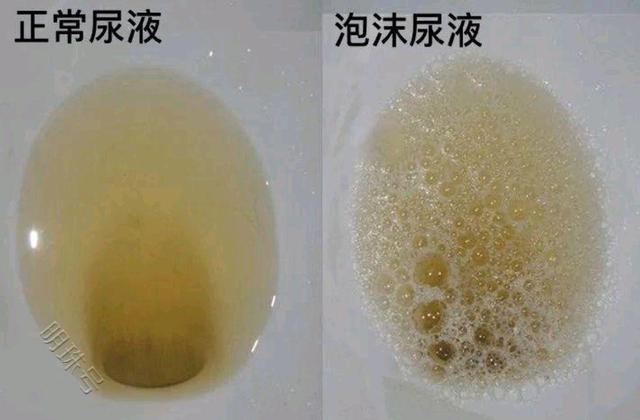 磷酸盐尿图片