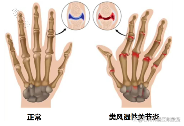 類風溼關節炎的個體性差異大,多以緩慢而隱秘的方式起病.