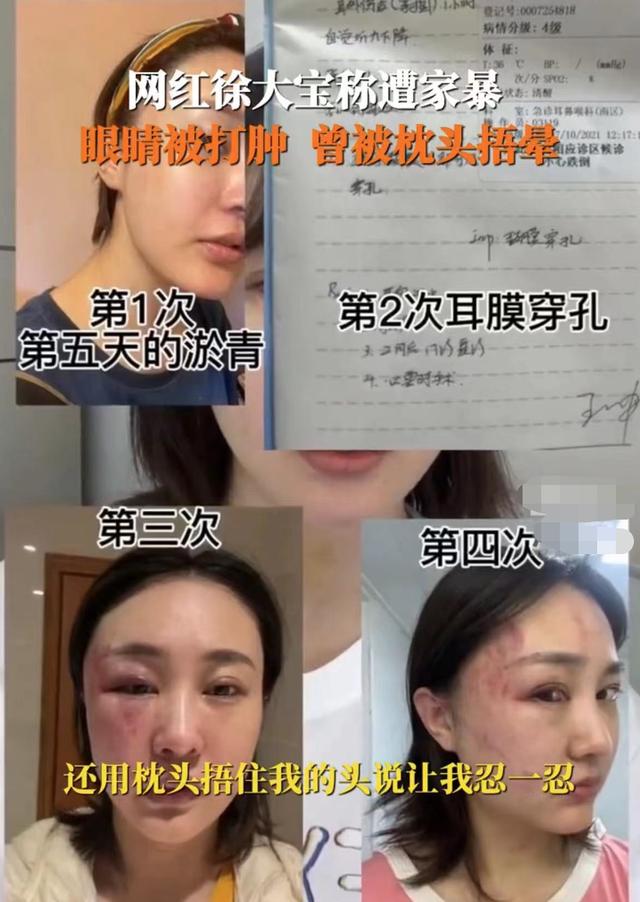 演员徐大宝遭家暴现身派出所，打到眼出血被鉴定轻伤，老公已拘留