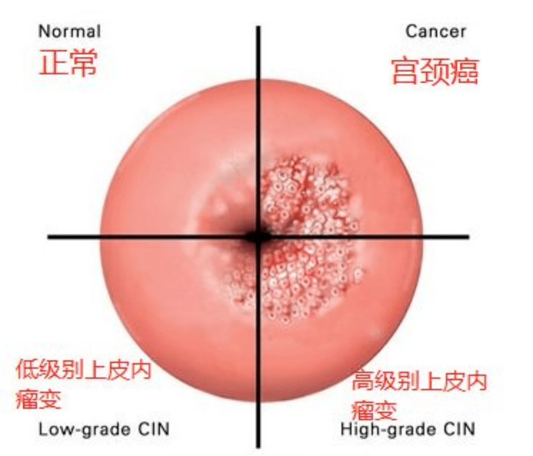 有的人年年体检，为什么还是查出癌症晚期？