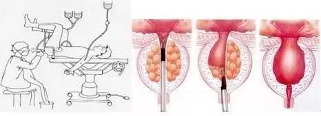 ③:手术治疗:主要有经尿道前列腺电切术,经尿道前列腺绿激光汽化术
