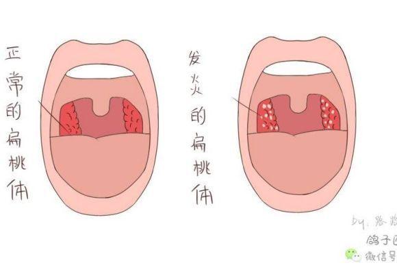 濰坊耳鼻喉專家普及腺體扁桃體肥大是什麼原因引起的