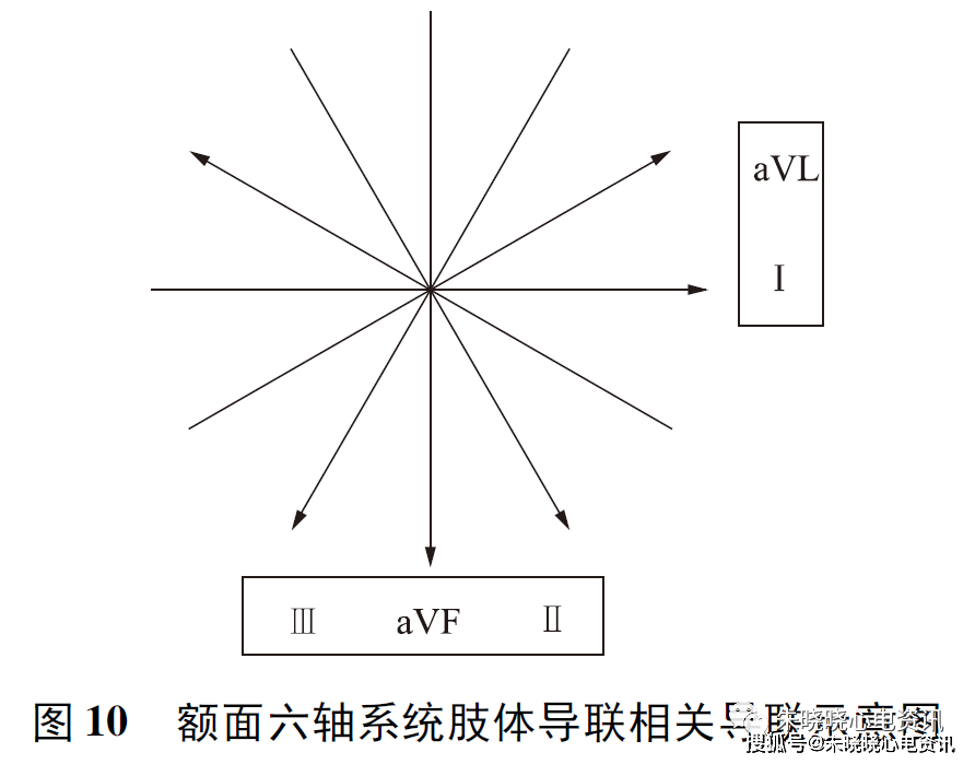 肢導聯新流程診斷vt的敏感性,特異性,準確性均高於brugada四步法