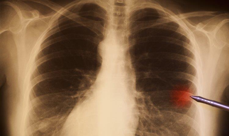 要当心这类咳嗽,是早期肺癌传出的第一个高危信号
