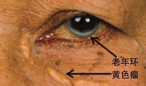 角膜老年环图片图片