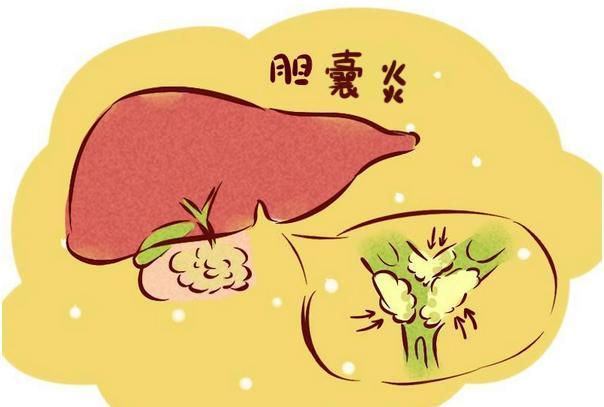 急性胆囊炎 yangsheng.eastday.com