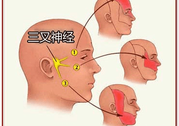 三叉神经痛部位图图片