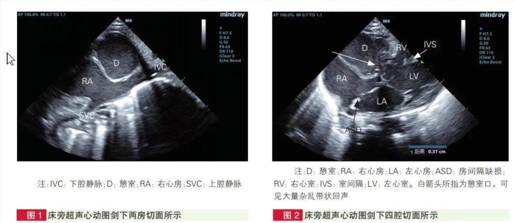 心臟超聲誤診的罕見左心室憩室【浙大兒童醫院病例】