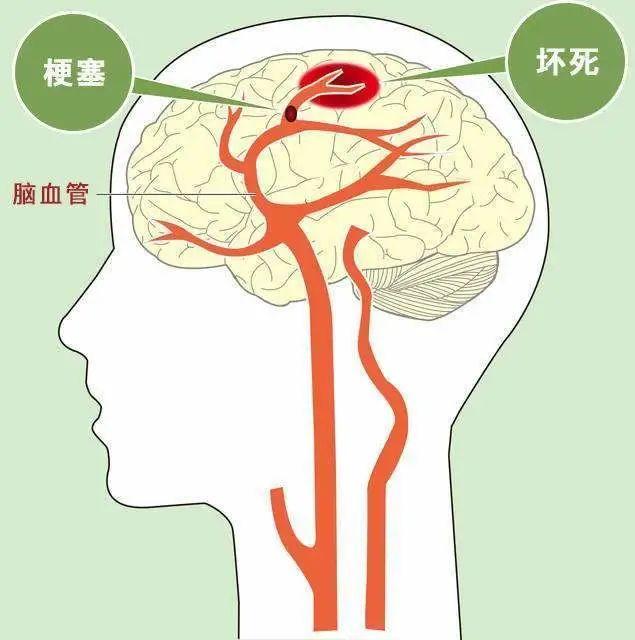 脑卒中你真的认识吗?检查cta和ct究竟有啥区别?