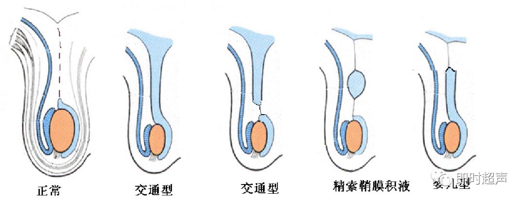 婴儿型鞘膜积液(睾丸精索鞘膜积液):睾丸鞘膜积液可能和精索鞘膜积液