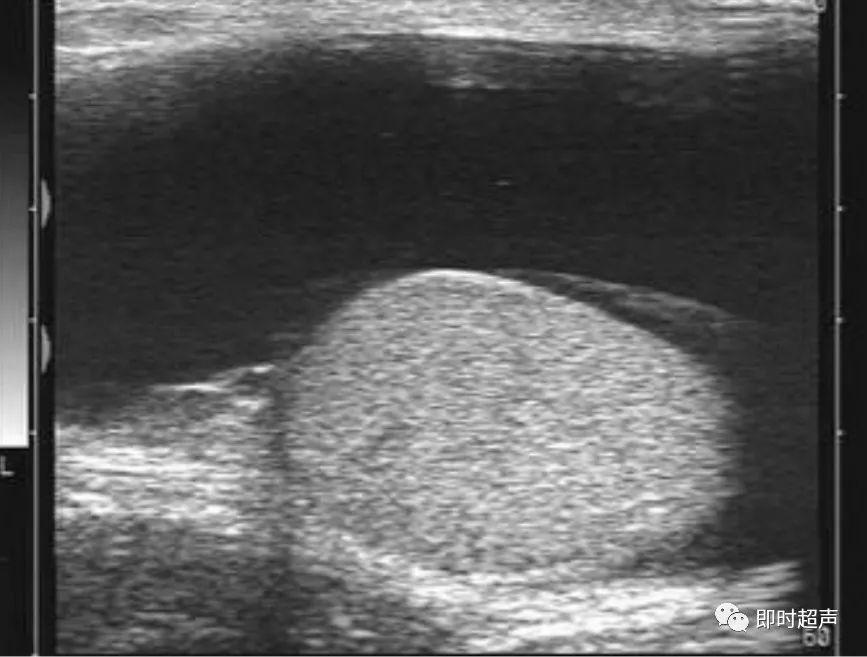 睾丸鞘膜积液与腹股沟斜疝的超声诊断
