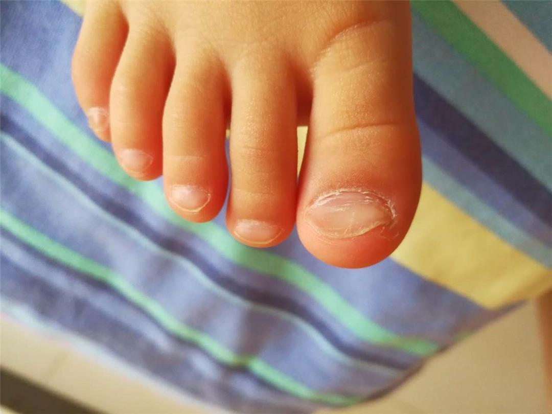 小孩的脚趾甲发黄变厚，怎么办 - 百度宝宝知道