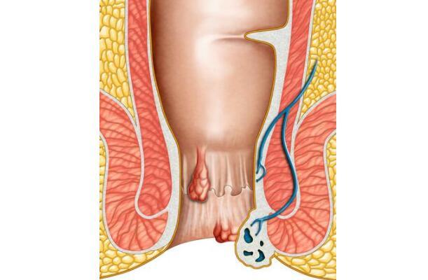 夏季肛門周圍很癢是天熱鬧的醫生當心5種疾病纏上身
