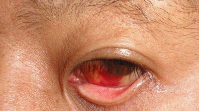 糖尿病眼病是致盲因素之一?它能损伤眼睛的,什么组织结构?