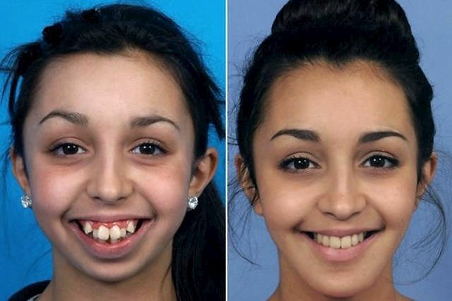 骨性龅牙可以不做手术进行矫正吗?