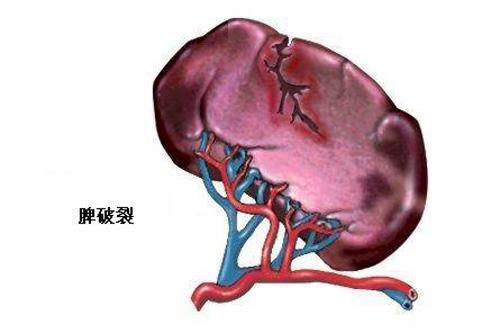 这是有多危险——当腹部外伤导致迟发性脾破裂