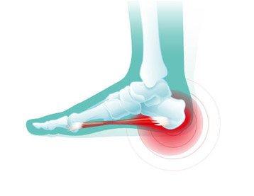 足底筋膜炎足跟痛崴脚跟腱炎痛风拇外翻您是哪个位置疼痛