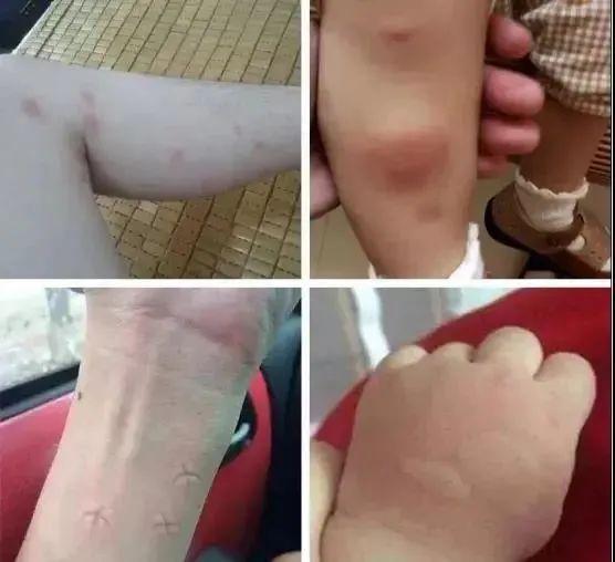 只因挠破蚊子包,4岁女童大腿坏死险丧命:被蚊子叮后的第一件事,99%