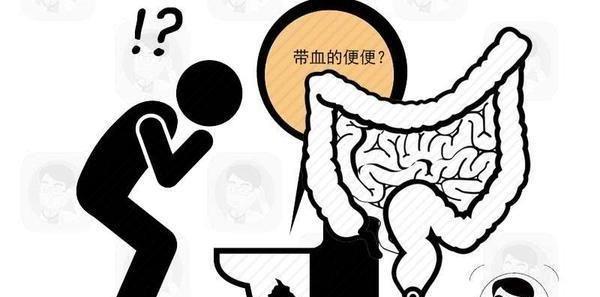 內痔後期有哪些症狀這4種情況可能接連出現需及時控制