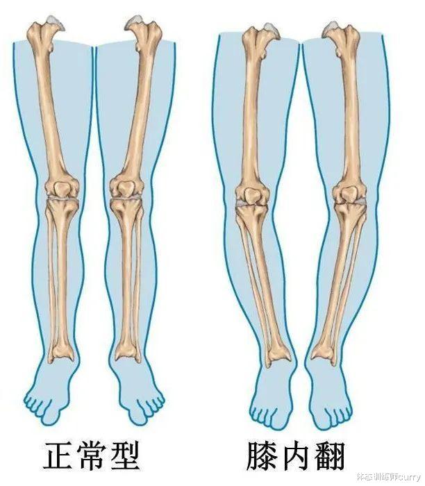 下肢鏈之殤膝內翻o型腿初探