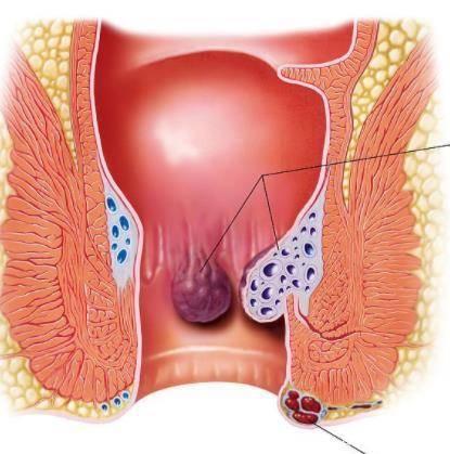 血管肿型痔疮图片图片