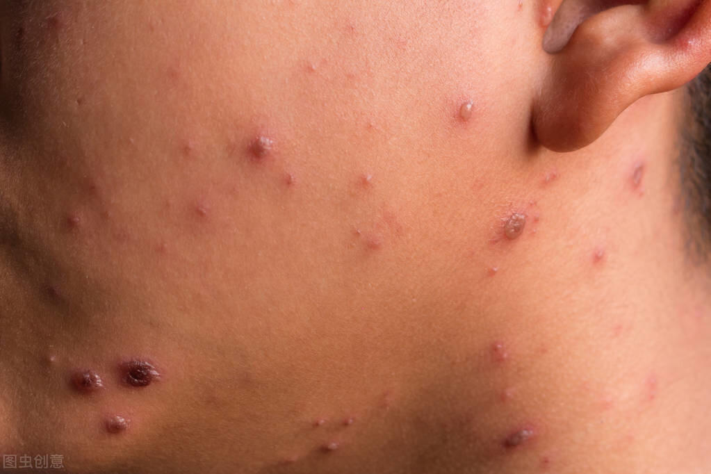 梅毒患者的皮疹,血液,唾液,乳汁及分泌物中都有梅毒螺旋体存在