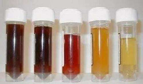 1,没有尿液颜色异常:一般情况下,我们尿液的颜色为淡黄色,而早上晨尿