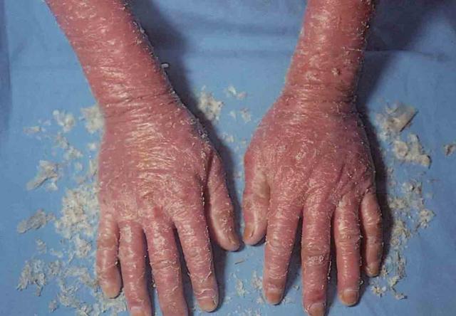 皮肤磨损,压迫或外伤碰撞皮肤,易诱发大疱性表皮松解症