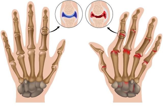 手指肿痛僵硬,有结节,预示着哪些疾病?医生详述常见的6种病因