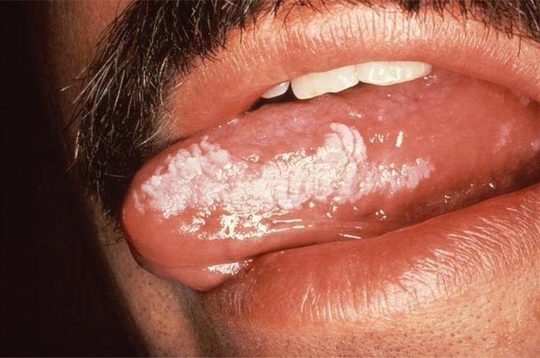男子口腔溃烂久治不愈,竟然是舌癌!舌头出现这些表现要注意