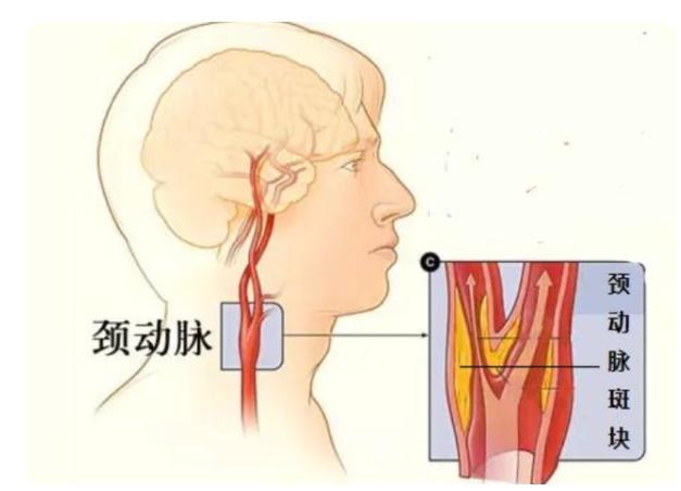 脖子颈动脉位置图片图片