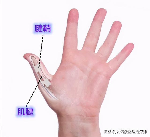 分别是在手腕上的桡骨茎突狭窄性腱鞘炎和手指上的指屈肌腱狭窄性腱鞘