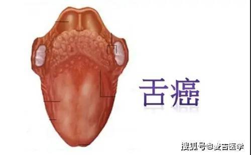 舌癌图案图片