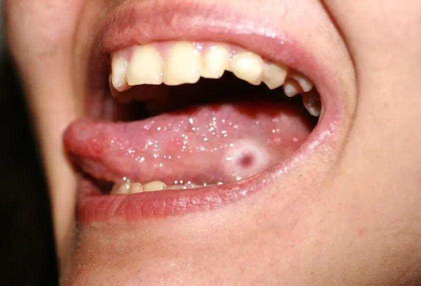 舌头癌症自测图片图片