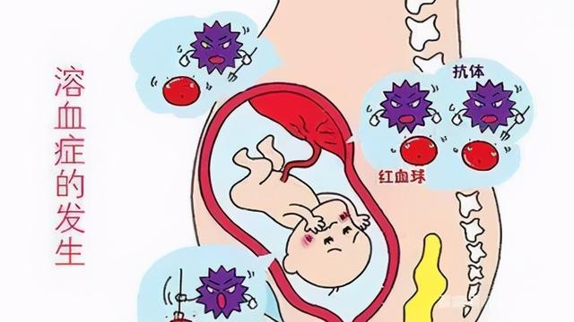 知識科普:溶血性黃疸有什麼特點?