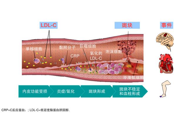 颈动脉斑块图片及说明图片