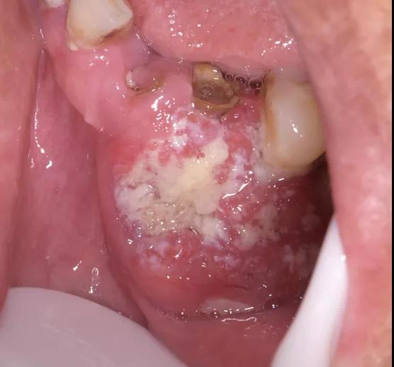 口腔溃疡癌变图片