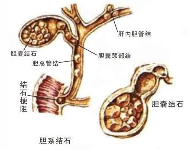 胆囊并非可有可无