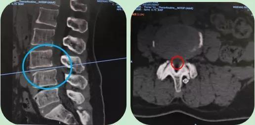 近年来在ube技术的基础上,相继开展了ube技术下腰椎间盘突出髓核摘除