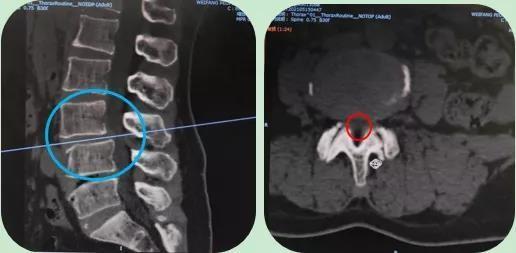 椎间孔狭窄ct图片