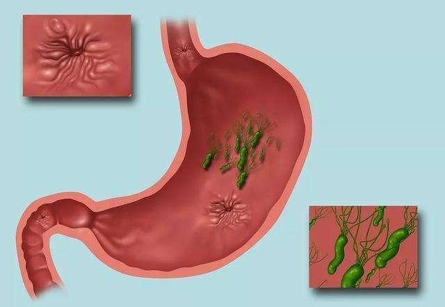 其實這其中的原理也不難,一旦感染了幽門螺桿菌以後,人體的胃黏膜就會
