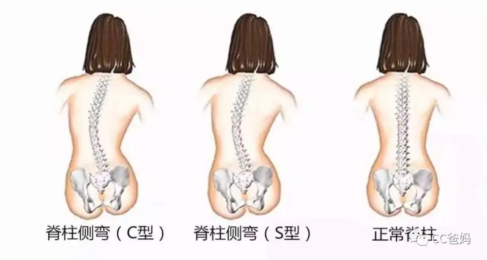 脊柱侧弯1到10度图片图片