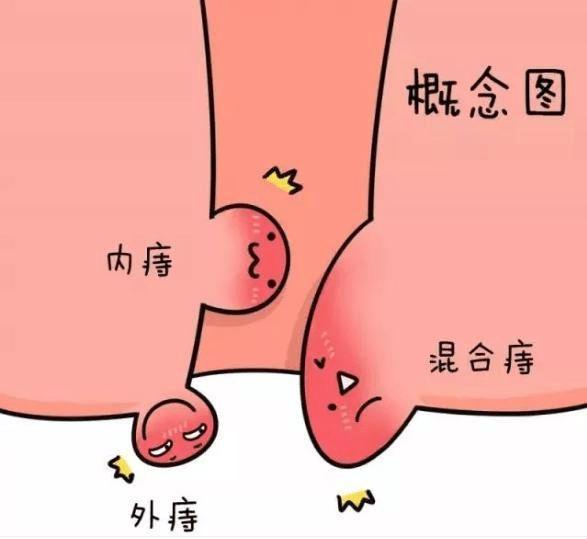 肛门长小肉芽图片图片