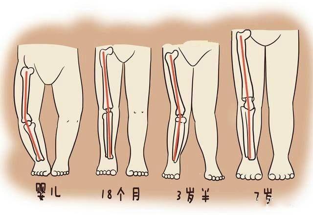 用尿不湿会导致孩子o型腿?