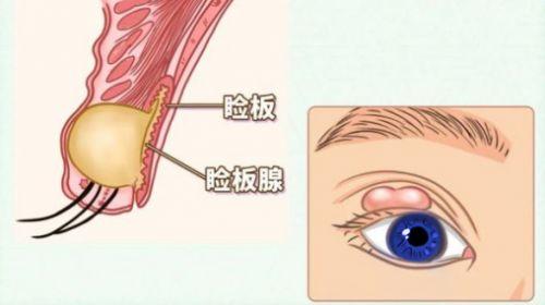 麥粒腫霰粒腫傻傻分不清?金麗文:九問九答揭秘眼睛上的