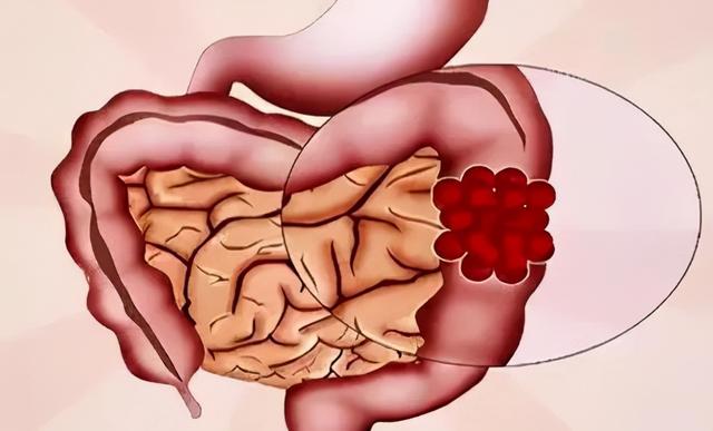 從腸息肉到結直腸癌:一條完全可以阻斷的路