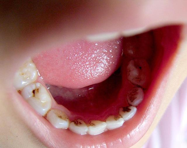儿童牙齿龋坏率这么高,主要原因有三个,看看你家中了几个?