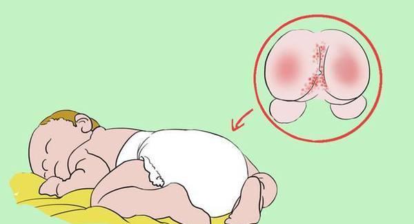女婴尿道两边红两侧图片