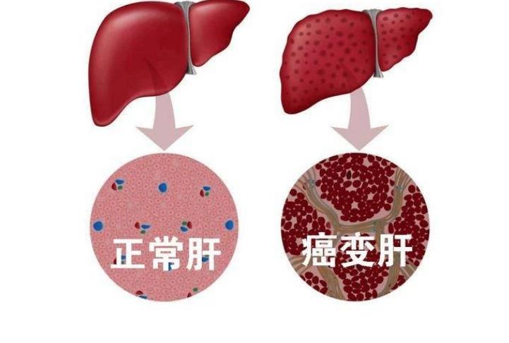 夫妻雙雙確診肝癌悔恨痛哭醫生嘆息刷鍋1習慣害了自己